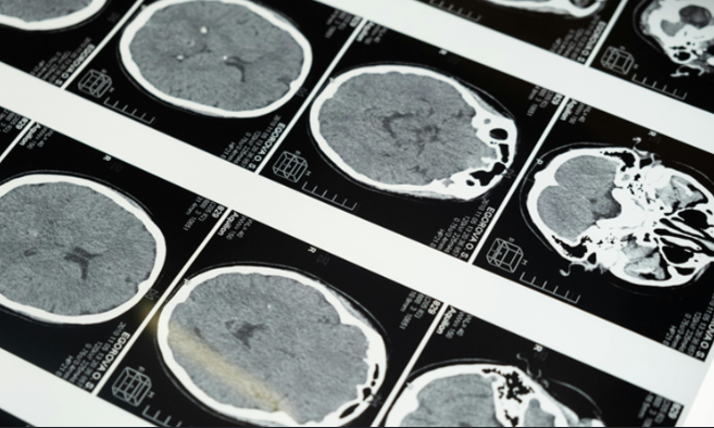 「阿茲海默新藥臨床效益研究」專家意見